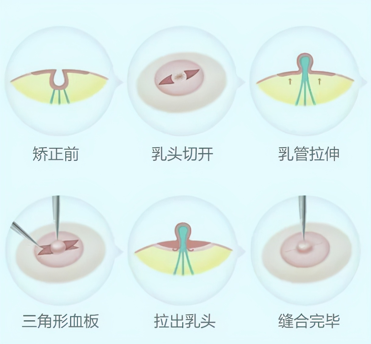 乳头内陷危害知多少？