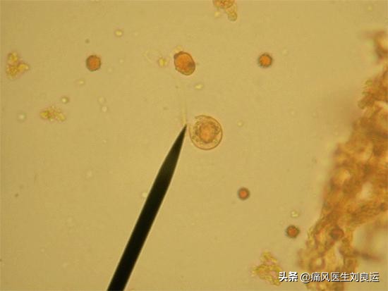 痛风患者降尿酸选哪种药？七种方法分辨尿酸生成过多还是排泄减少