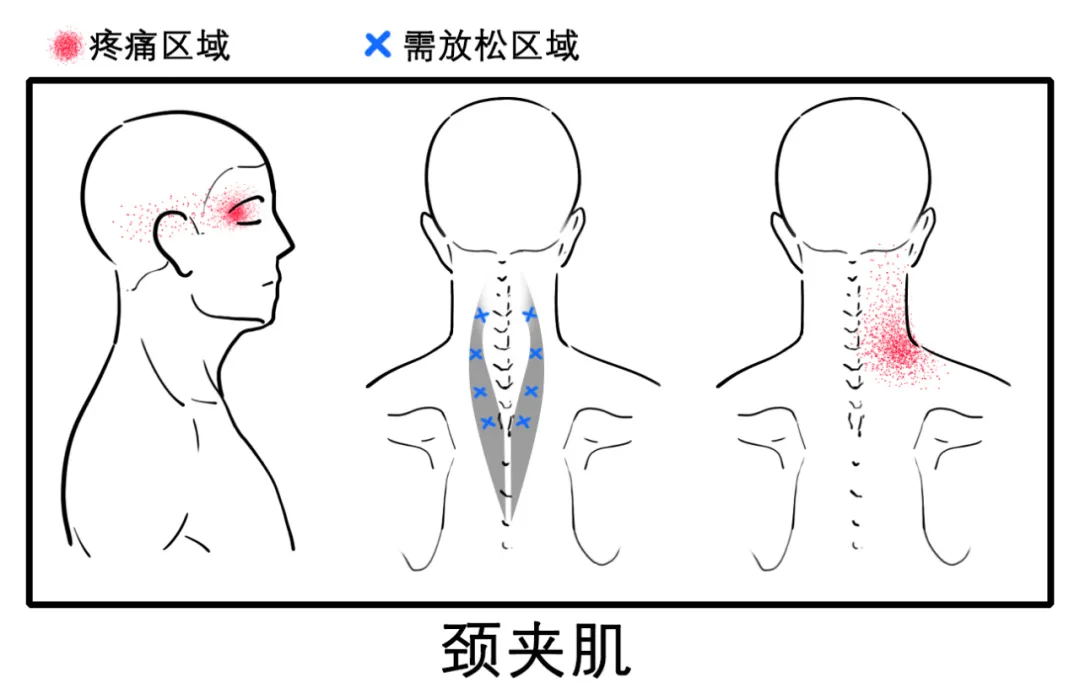 八成头痛和颈椎有关!一份“疼痛位置图解”帮你对症放松