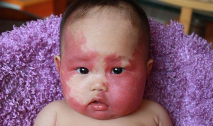 胎记是怎么来的？产科医生：孕期避开这3种行为，以免伤害到胎儿