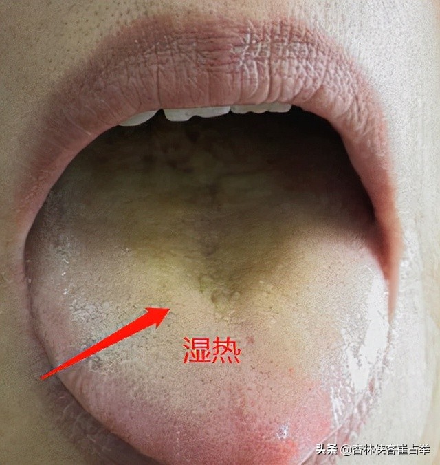体内湿热重难调理？中医教你有效祛湿清热