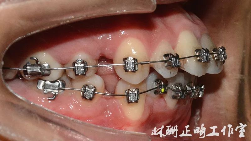 福州牙齿矫正 | 前突龅牙患者害怕骨钉,改用z钩获得很好的内收效果