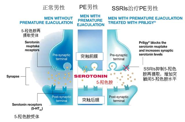 告别“男”题烦恼，国产盐酸达泊西汀片上市，真能助力加时赛？