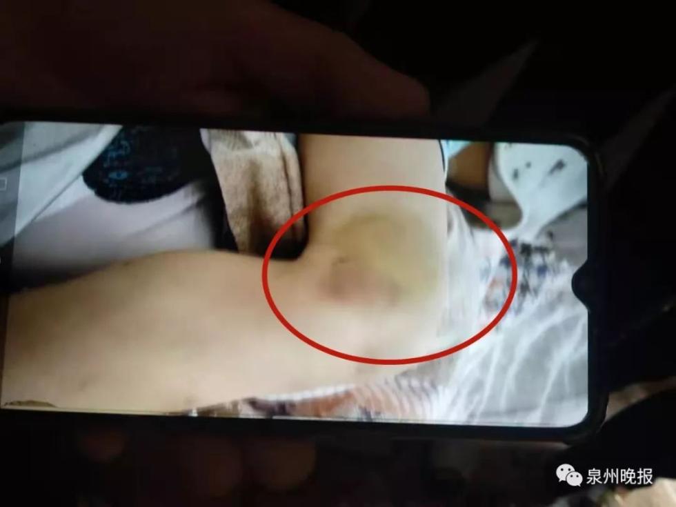 男童遭继母虐待,