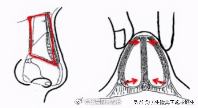 侧脸高鼻梁正脸矮塌鼻，鼻骨过宽惹的祸，鼻骨内推了解下