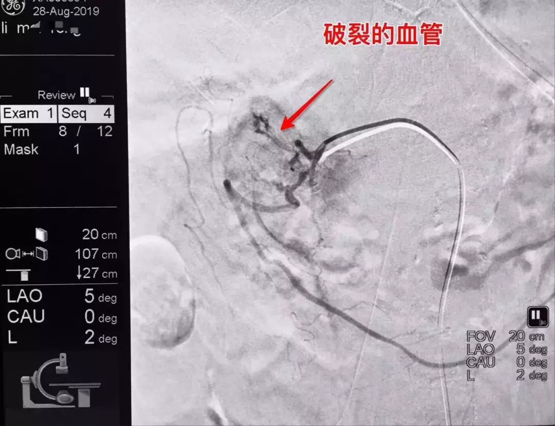 76岁老人急性胃出血1500ml，用了这种“武器”，马上止血