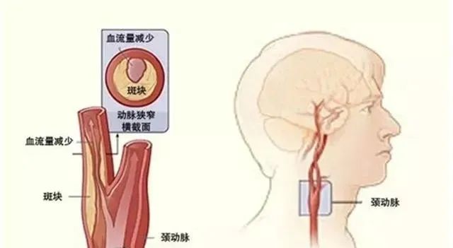 引起动脉硬化的因素有哪些？动脉硬化如何预防呢