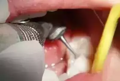 你补过牙吗?知道价格为什么差那么多吗?