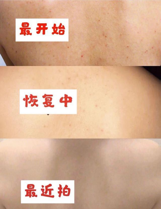 後背奇癢難忍?去醫院檢查竟然發現上萬只蟎蟲,連醫生都傻眼