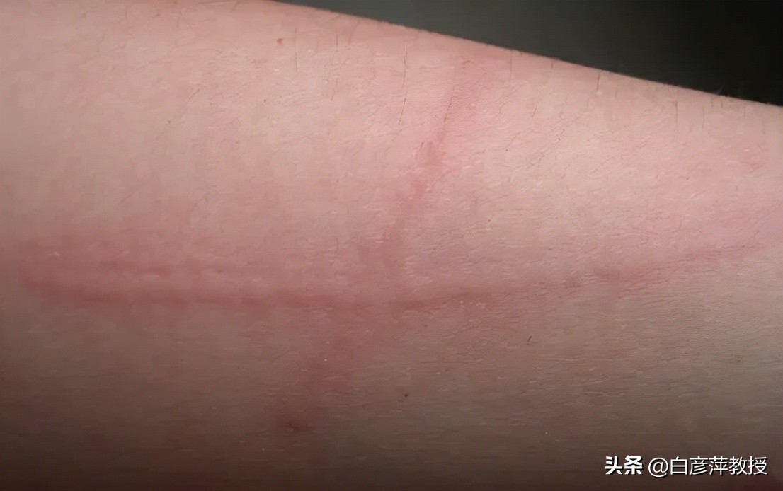轻轻一划，皮肤上就凸起一道红痕？要警惕皮肤划痕症“作怪”