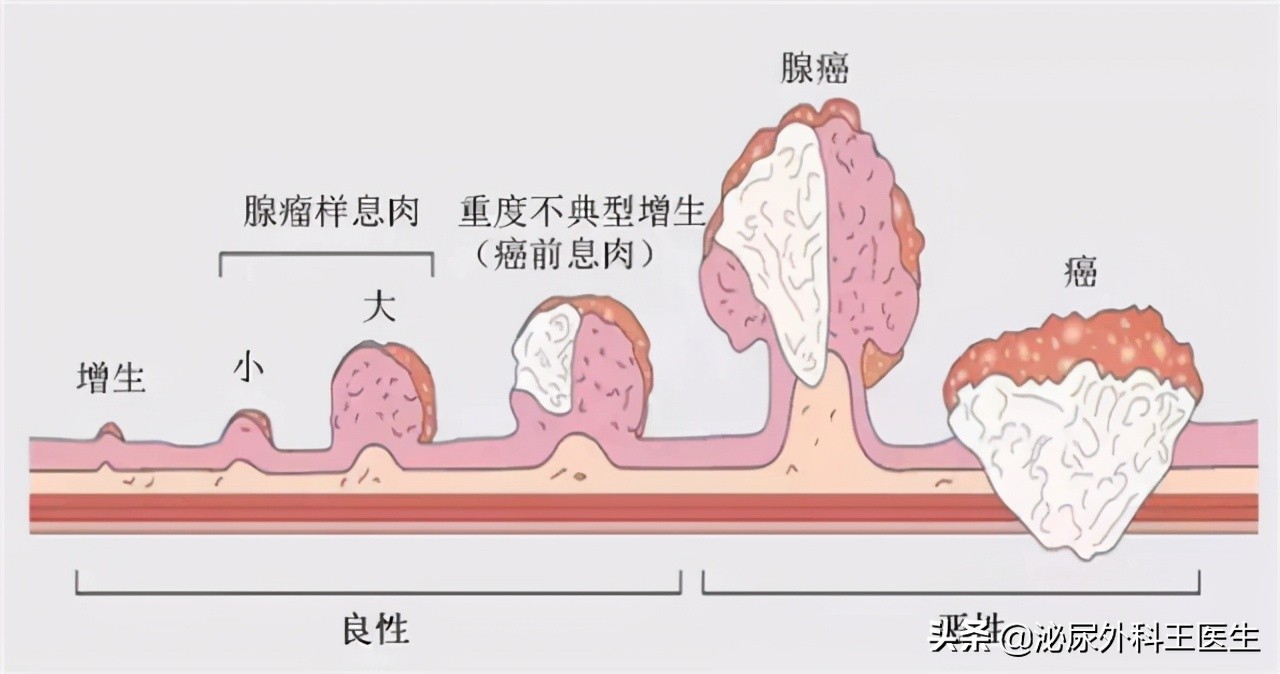 "难以启齿"的肛门癌,你了解它吗?出现几个症状,及时就医检查