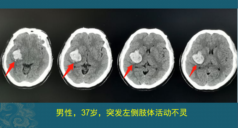 一瓶降压药值多少钱？3千到7万，这不是玩笑