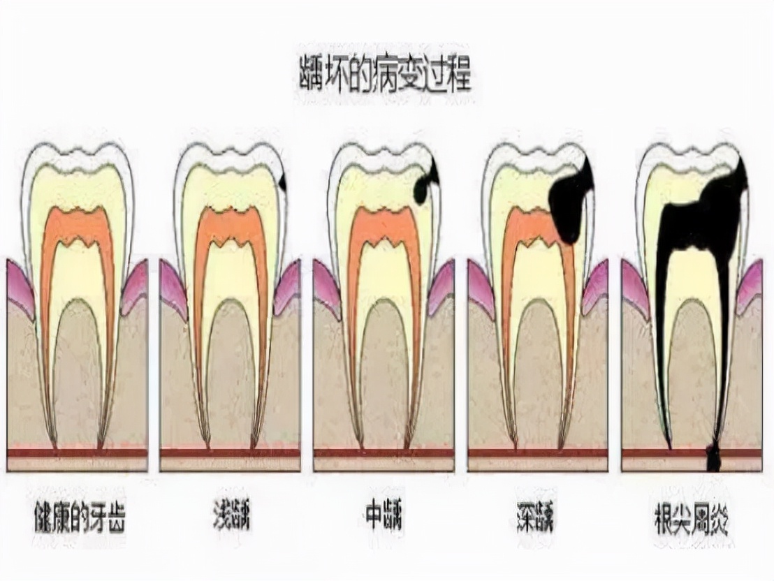 牙疼太痛苦，可是你知道有一种药，是专门预防龋病的吗？