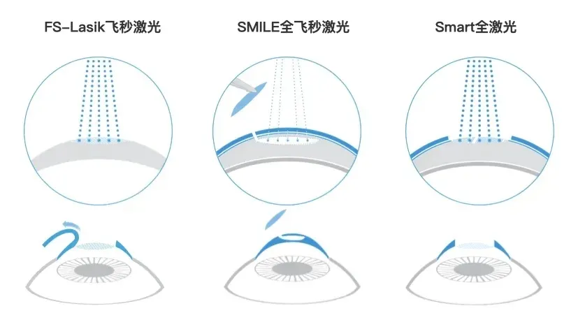 做一次激光近视手术，到底要多少钱？