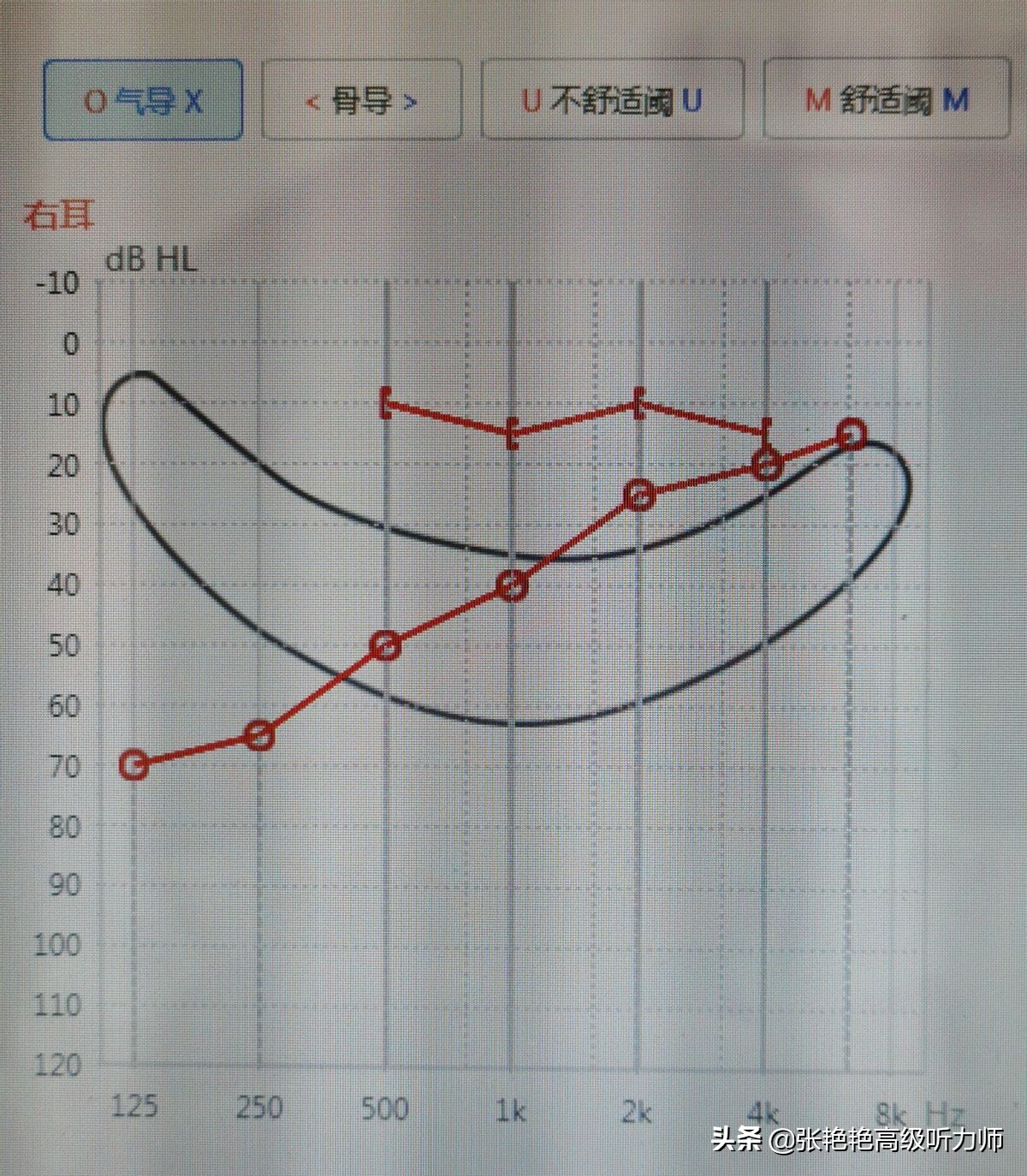 耳聋越重，配的助听器越贵？轻的话配个便宜的就行？看专家怎么说