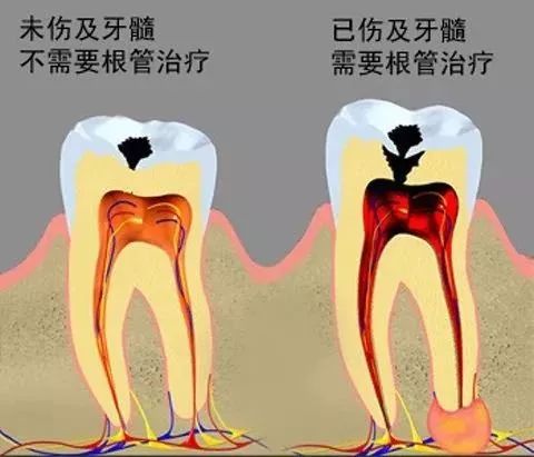 补牙要趁早！小龋坏久拖不治，最后花费上万，冤不冤？