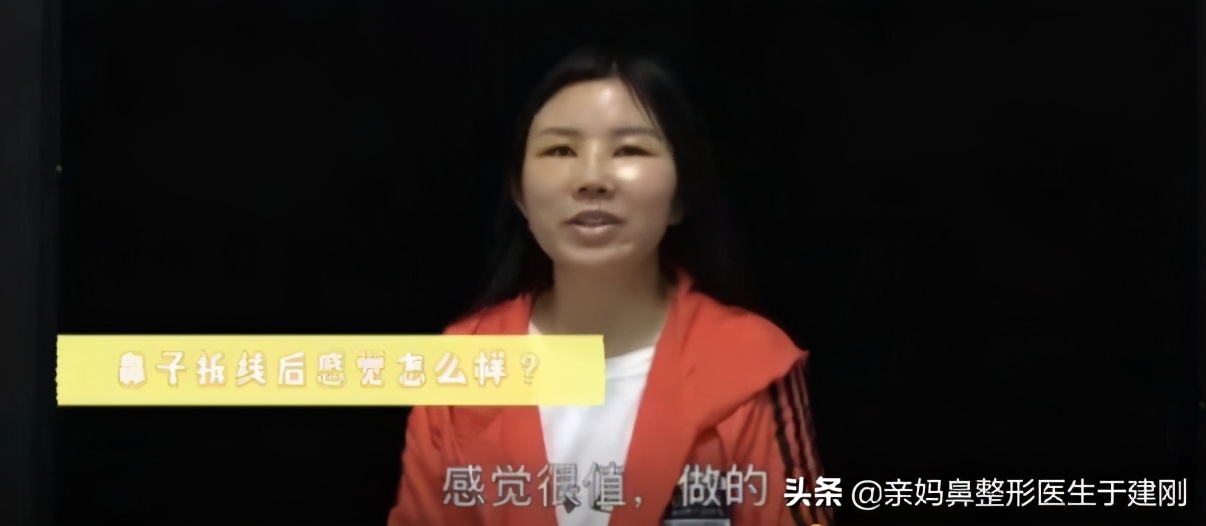 肋软骨鼻修复改善L型鼻，31岁妈妈拒绝歪鼻，术后变回气质宝妈