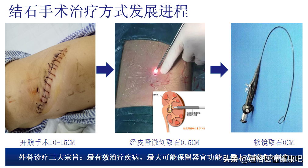 体外冲击波“碎石”和输尿管软镜“取石”，谁更“胜”一筹？