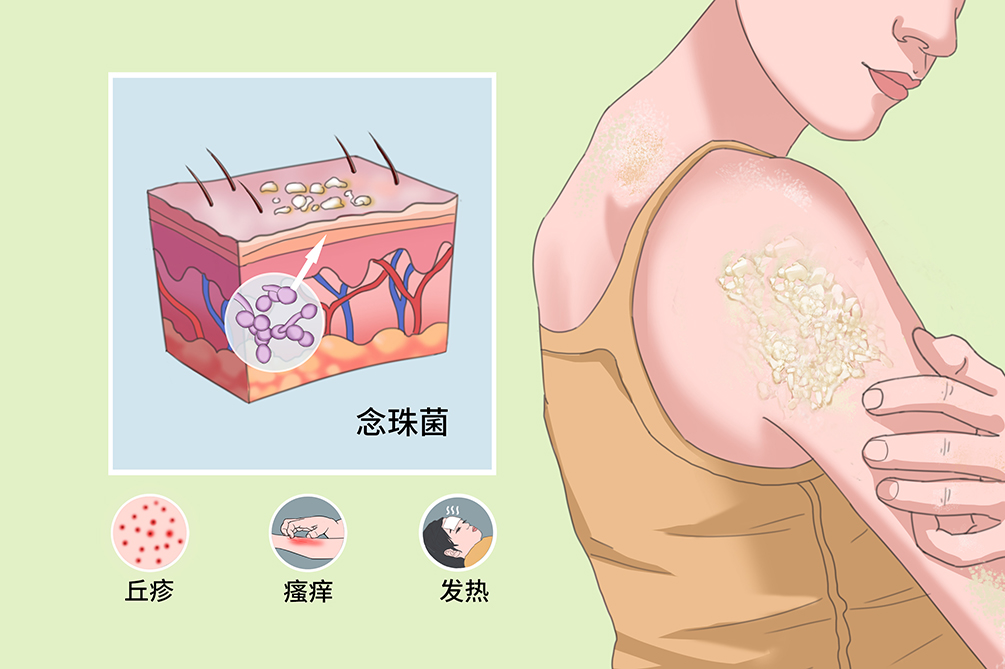 念珠菌病是由各种致病性念珠菌引起的，好发于机体免疫低下的患者