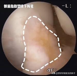 膝盖疼的不敢动，做核磁没有积液，是滑膜炎吗？医生帮您分析下