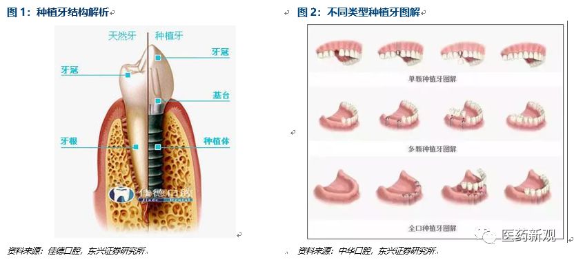 种植牙行业报告：核心技术国外垄断，每颗种植牙成本2000卖1万