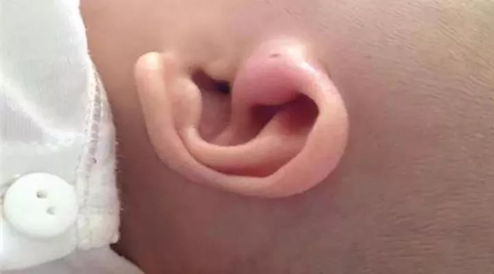 耳朵上有个小洞，是福气、聪明的象征？你可能不知道……
