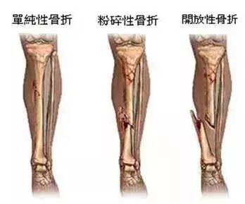 骨科那些“拍片”，你知道该怎么选吗？