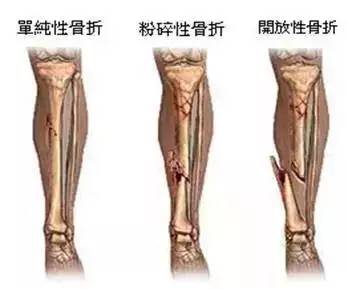 骨科那些“拍片”，你知道该怎么选吗？