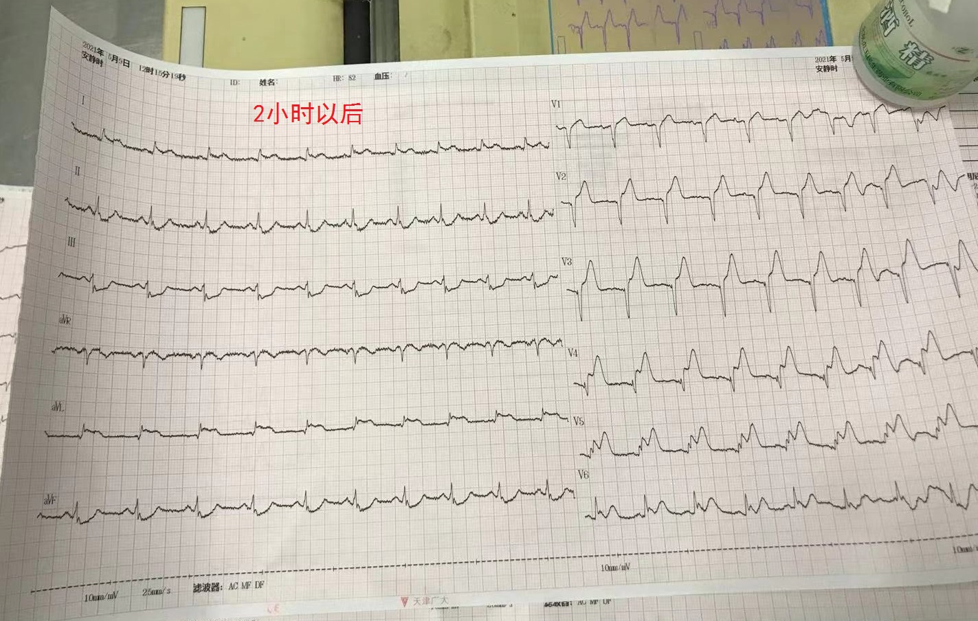 st段压低是什么意思(这个心电图也很危险) - 百百科
