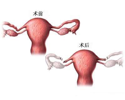 在你心里，女性结扎就真那么不好？听听妇科医生的心声