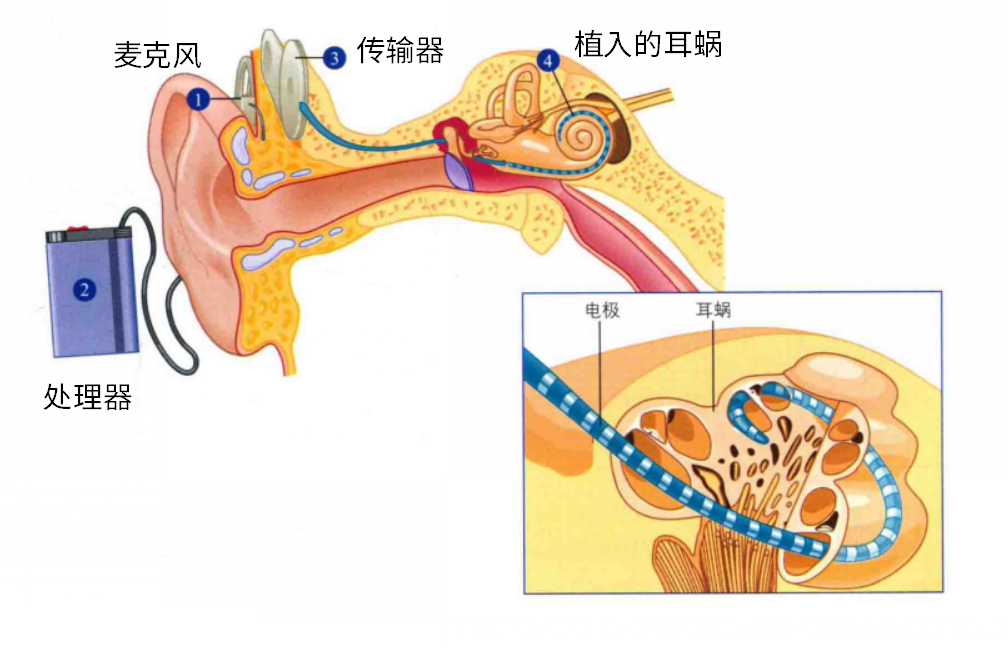 人工耳蜗和助听器区别图片