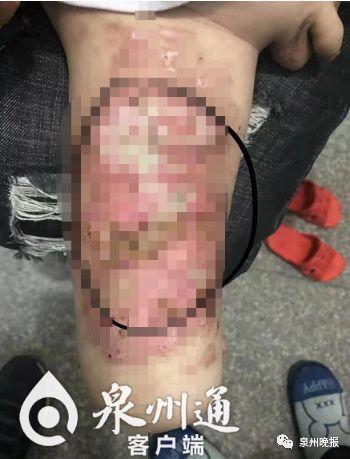 男童遭继母虐待,