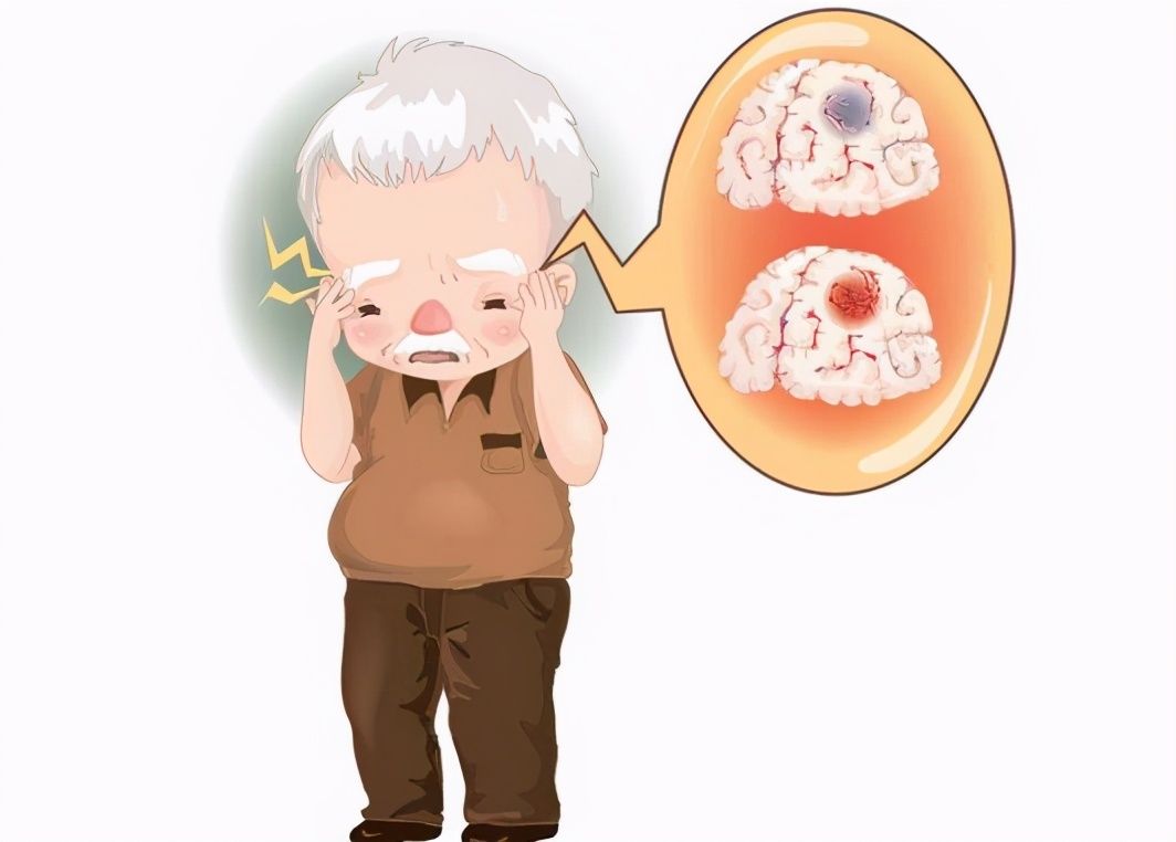 农村地区脑梗死的发生风险更高？主要有这4个因素