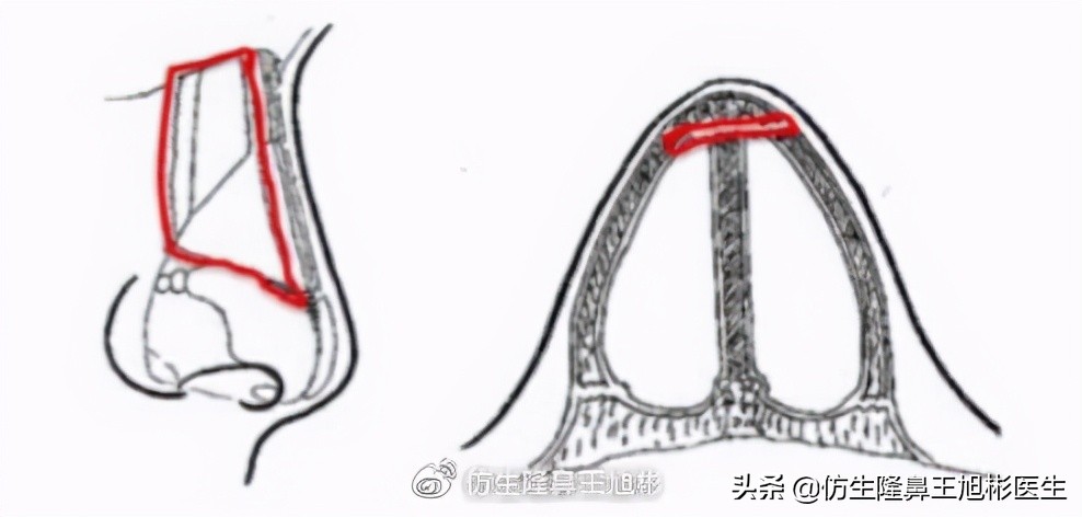 侧脸高鼻梁正脸矮塌鼻，鼻骨过宽惹的祸，鼻骨内推了解下