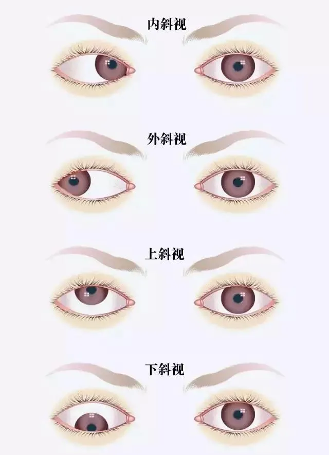 比起近视,这种眼部疾病更让孩子痛苦,可惜很多家长不知道