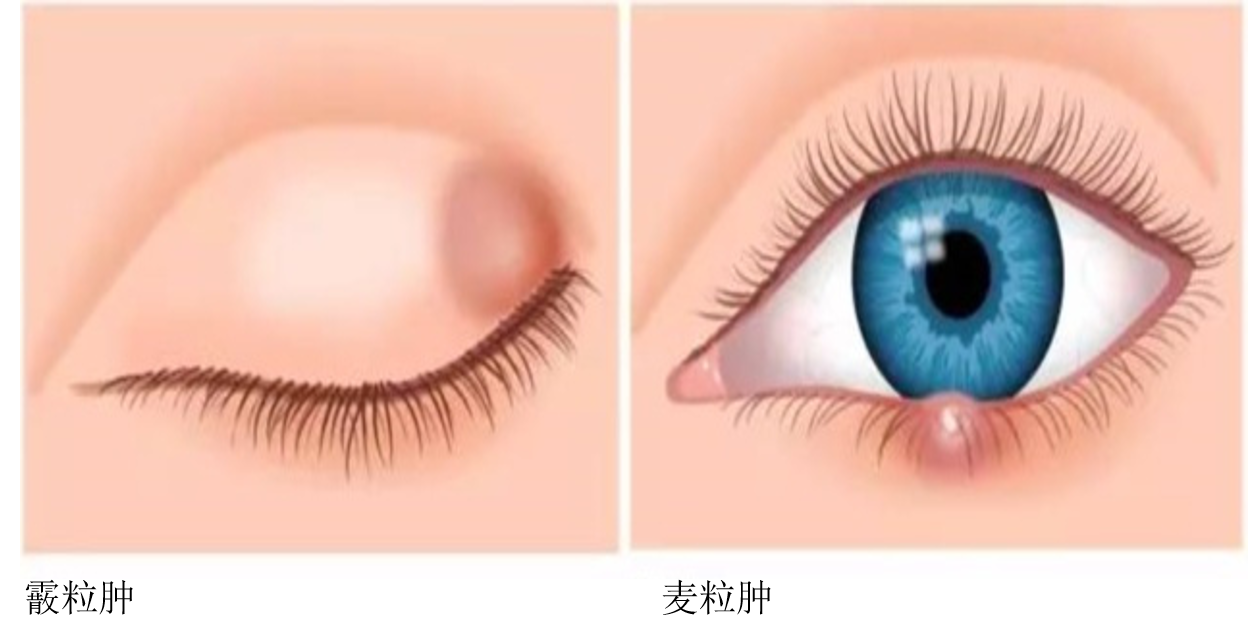 眼睑皮炎的症状图片(麦粒肿与霰粒肿) - 赤虎壹号