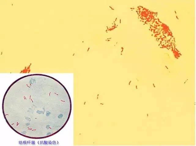 怀疑肺结核？这些检查方法帮你确诊
