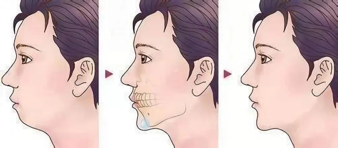 八字算命解析下巴短小的人面相3_达一风水网