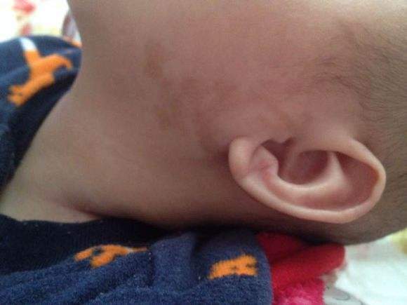 1,网格状胎记这种胎记称为网状青斑,是由局部血管收缩能力异常引发