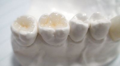 牙齿龋坏后需补牙，补牙材料选哪种好？牙医教你选便宜又好用的