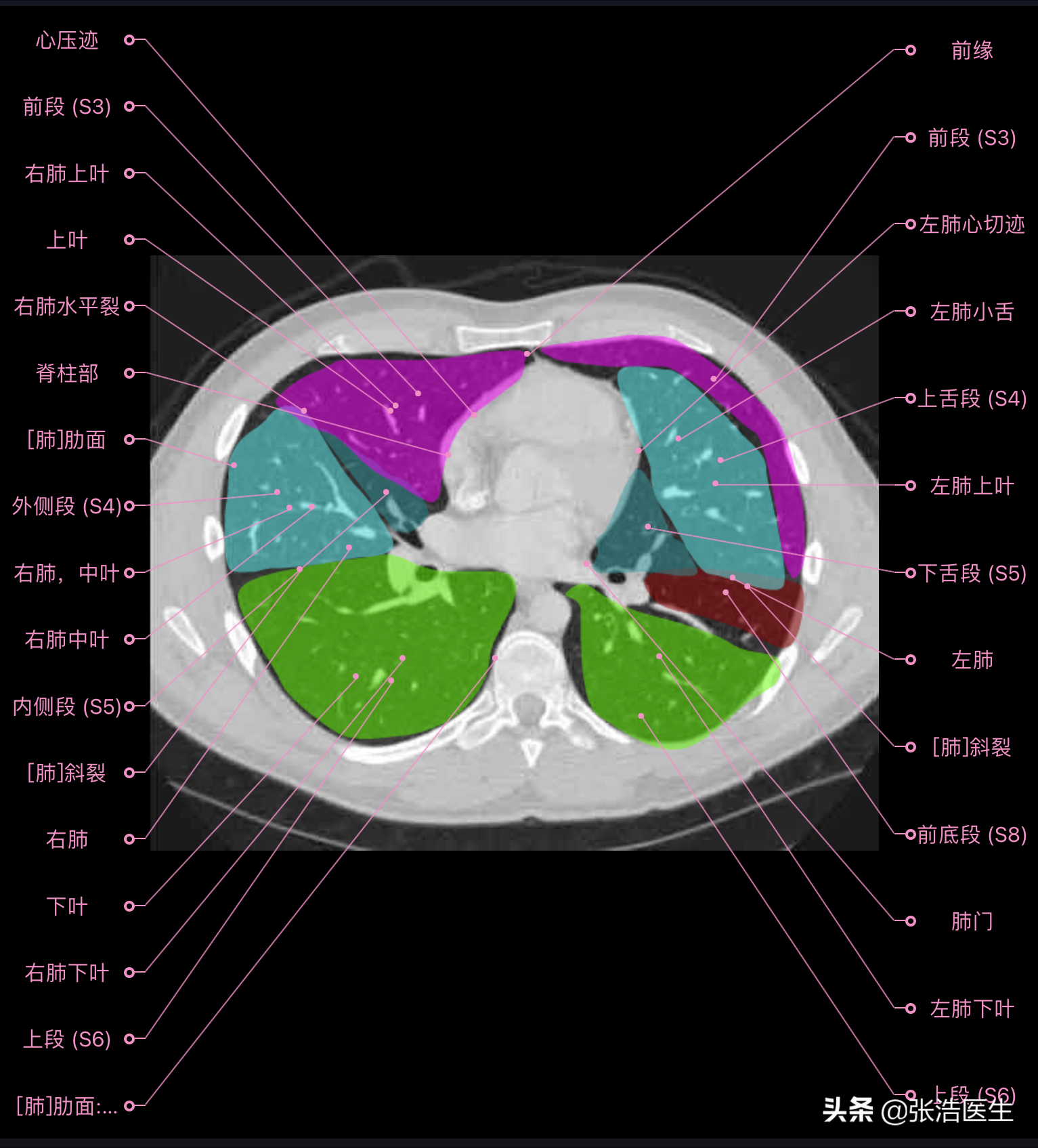 肺的分段分叶解剖图ct图片