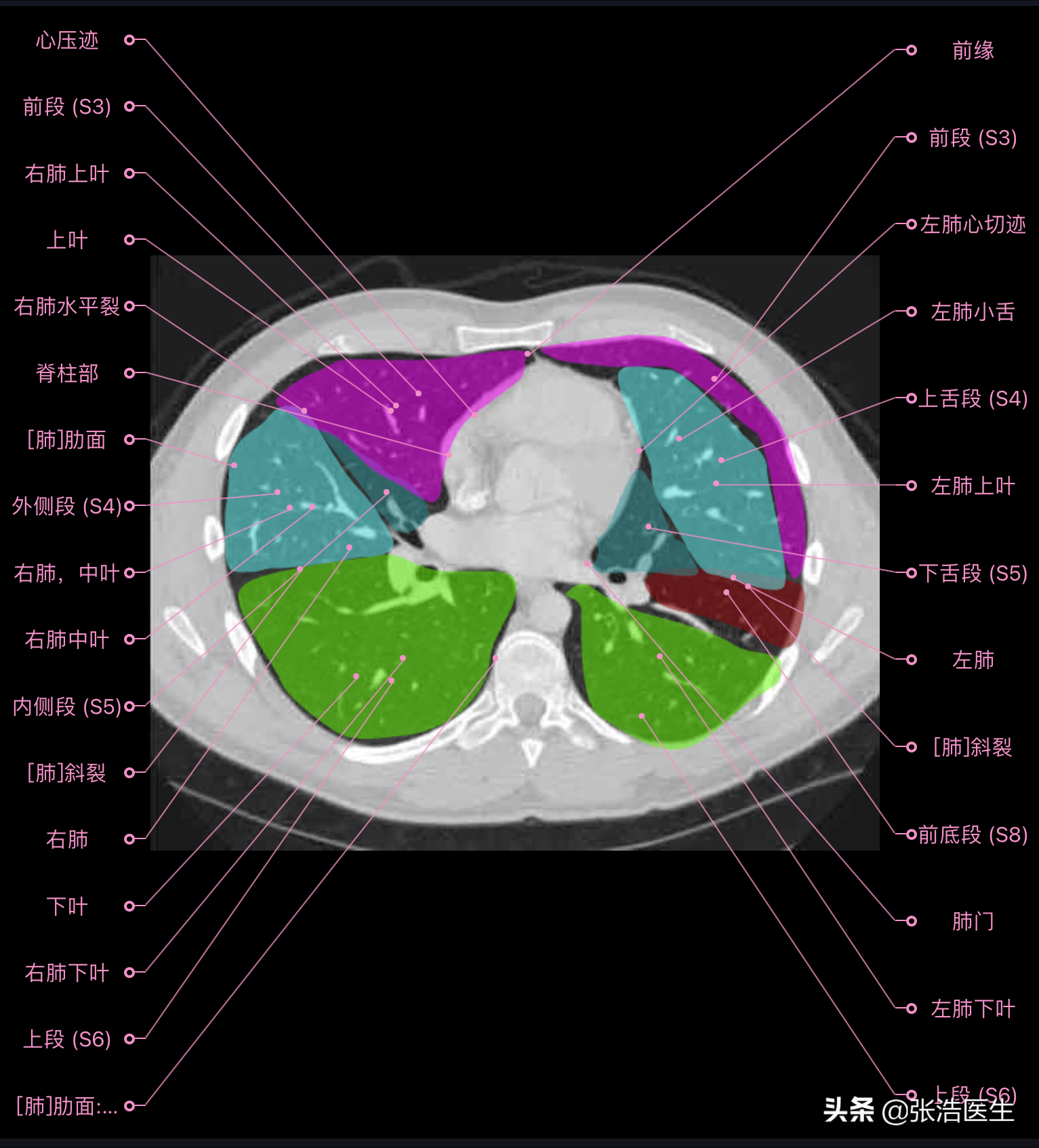 肺部ct解剖图 断层图片
