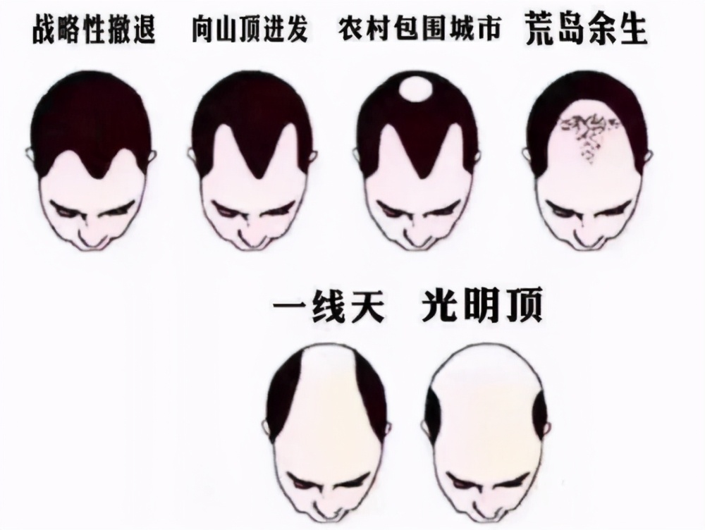 大学“越学越秃”4大专业，生发灵都拯救不了，有你的专业吗？