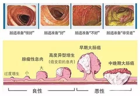 三类人群需定期做肠镜，了解检查流程很重要