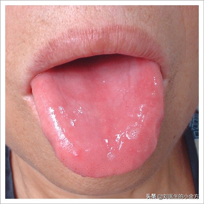 舌红少苔舌红少津剥苔镜面舌