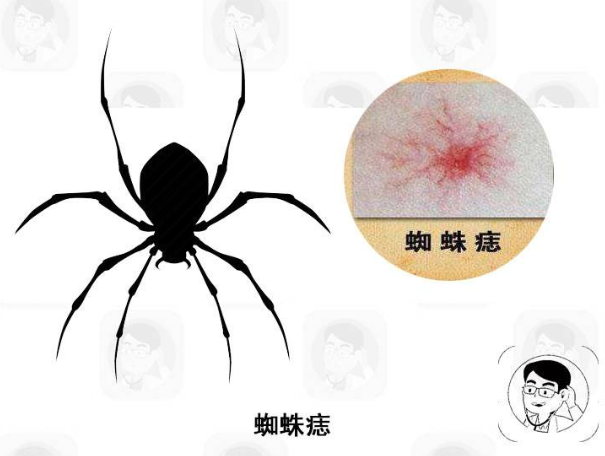 身上突然出现类似蜘蛛网一般的痣，可能是肝脏受损的表现，要小心
