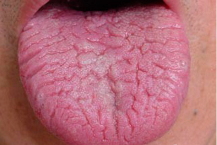 舌苔增厚,全舌发白是身体的什么信号?如何看舌头知健康?