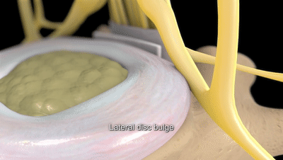 6个缓解腰椎间盘突出的伸展运动，避免7个训练，强壮腰椎不踩雷