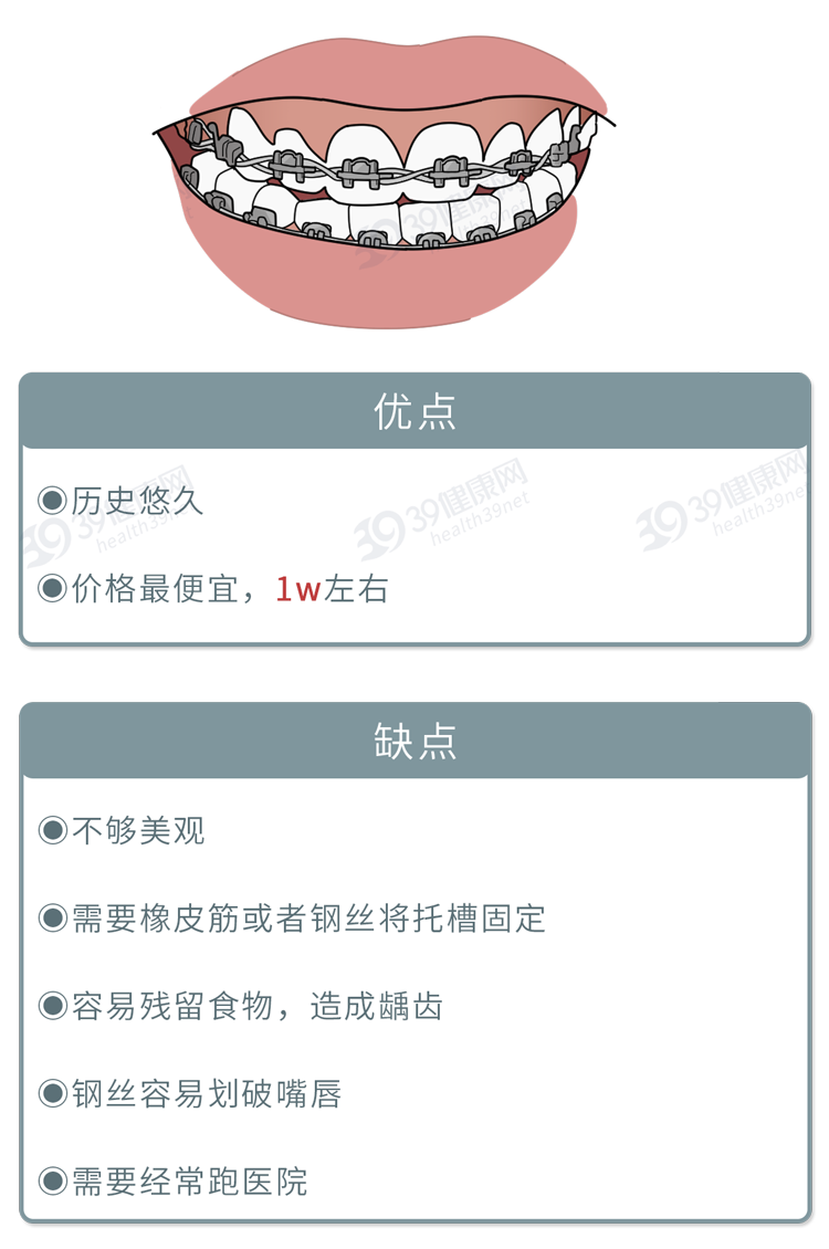 为什么只要戴牙套，牙齿就可以恢复得很整齐？生动展示矫正过程