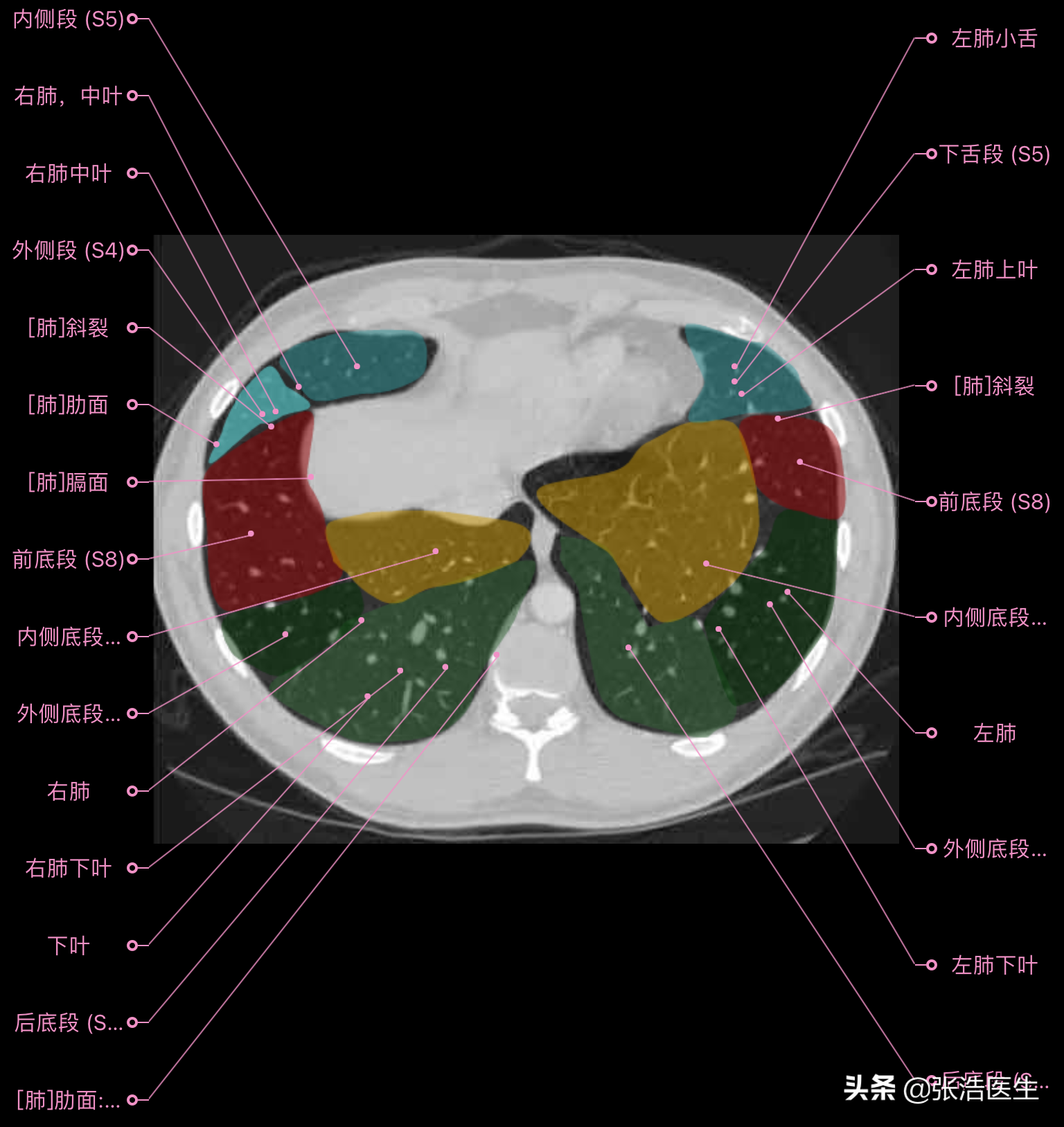 肺部ct高清解剖图谱,附带详细标注